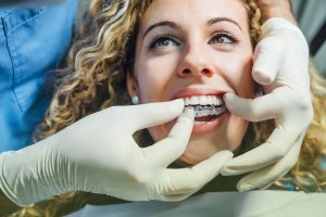 Invisalign