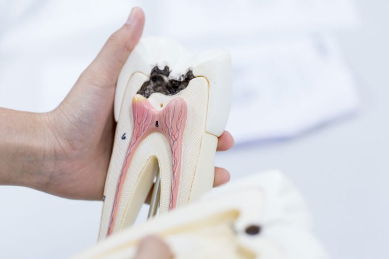 Dentist hand holding a dummy model of a tooth cavity to explain dental decay treatment at Dr. Brent MacDonald’s Calgary clinic.