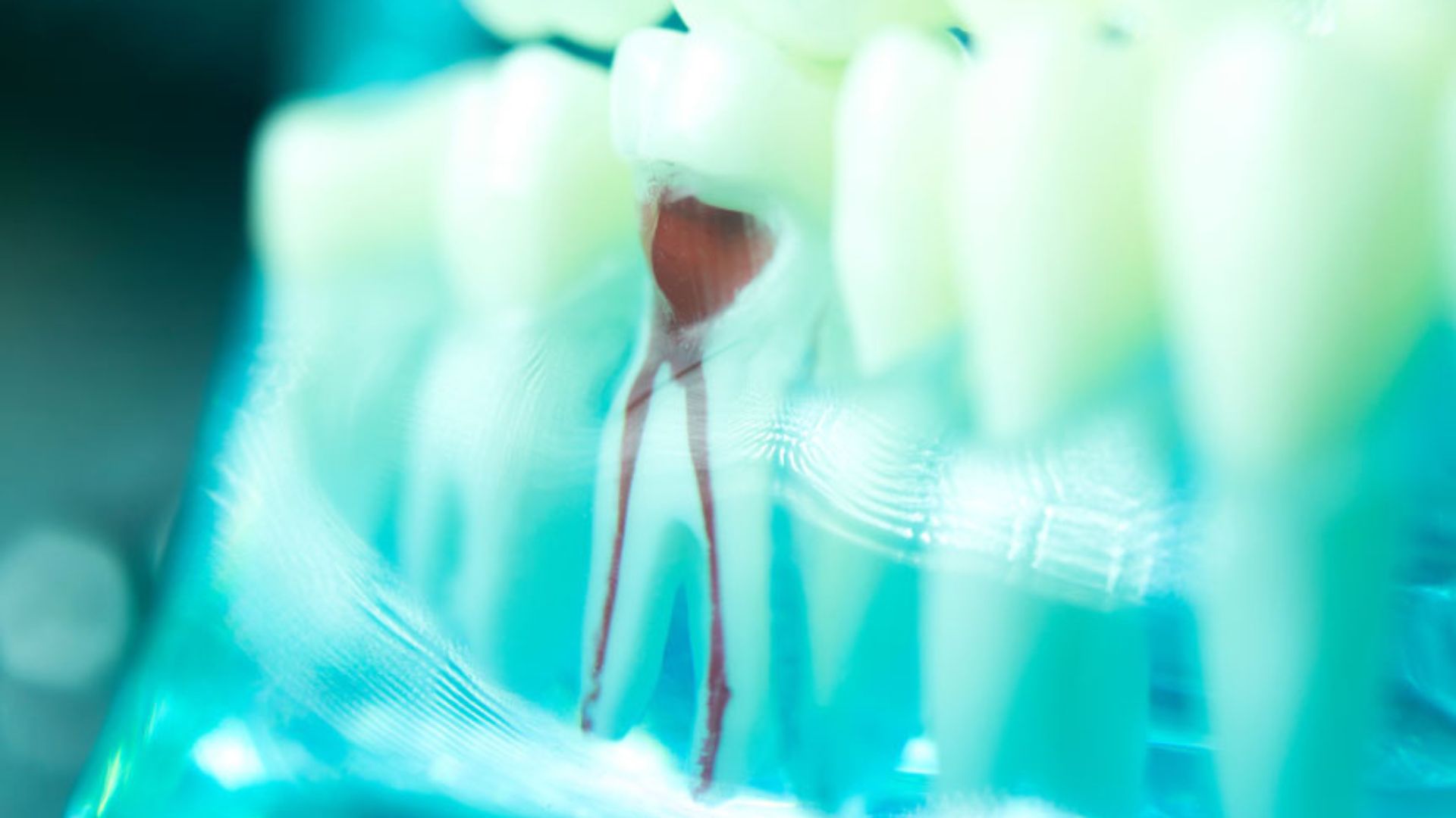 Detailed model showing root canal anatomy inside a tooth, used for patient education at Dr. Brent MacDonald’s Calgary dental clinic.